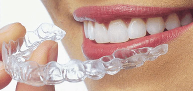 Aligners