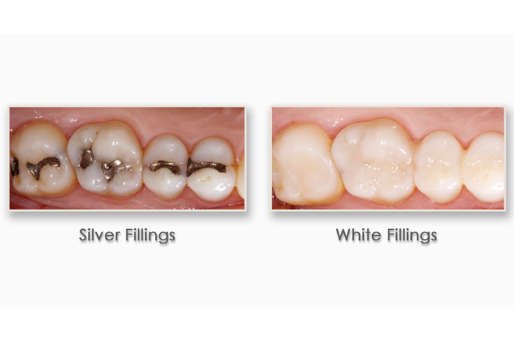 Dental Bridge 