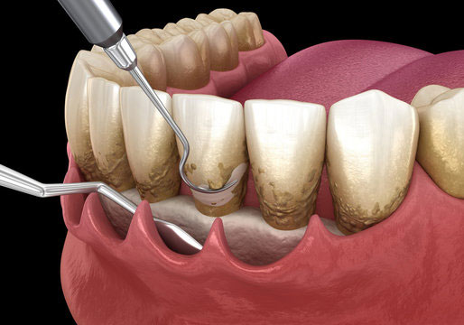 Dental Bridge