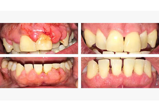 Dental Bridge 