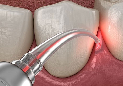 Dental Bridge 