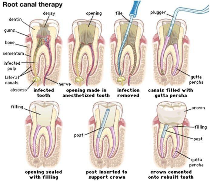 Method Of Rct